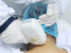 depilacion_laser_cervical_3