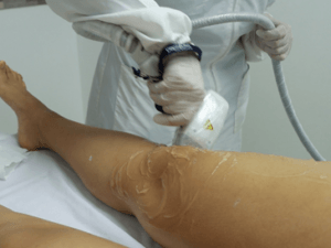 depilacion_laser_piernas_completas_2